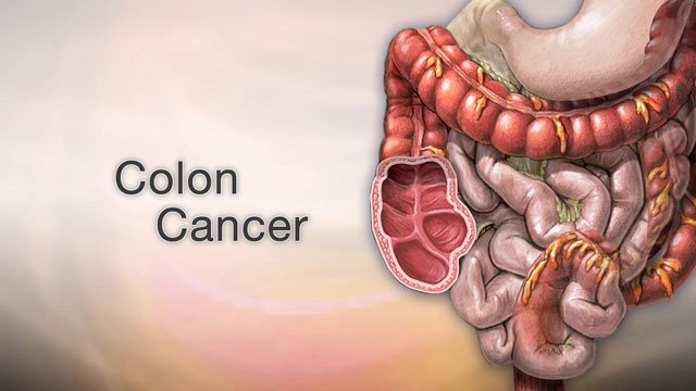 medical-oncologist-in-mumbai-colon-cancer