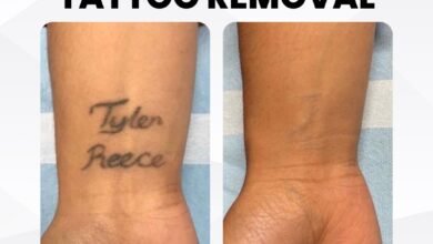 Tattoo Removal Singapore