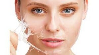 chemical peeling treatment