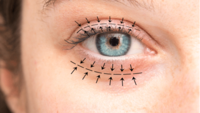 Blepharoplasty Scars What You Need to Know