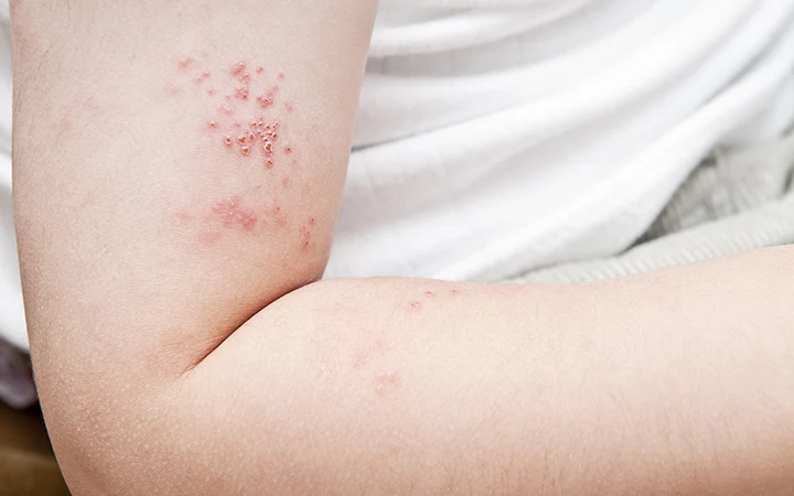 How to treat a bacterial skin infection