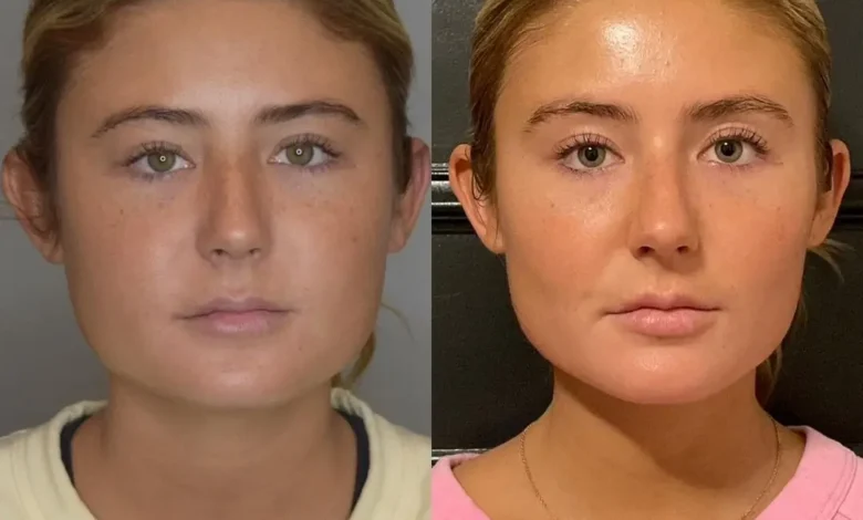 Buccal Fat Removal in Dubai