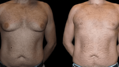 male breast reduction results