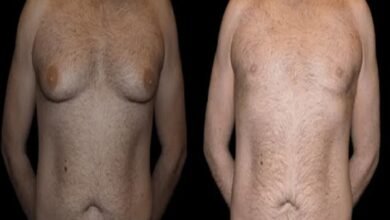 Before and After Male Breast Reduction Results