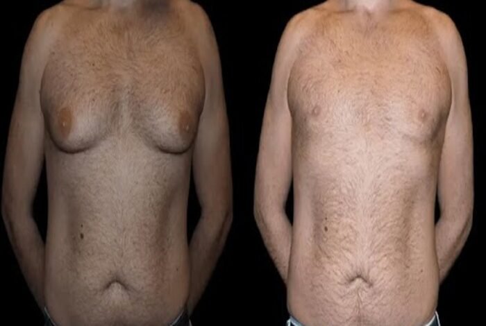 Before and After Male Breast Reduction Results