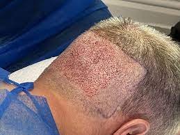 FUE Hair Transplant: A Revolutionary Approach 