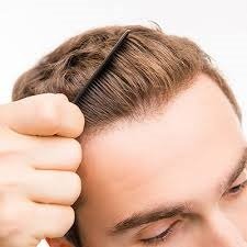 Hair Transplant in Riyadh