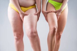 How Liposuction Can Help You Sculpt Your Body