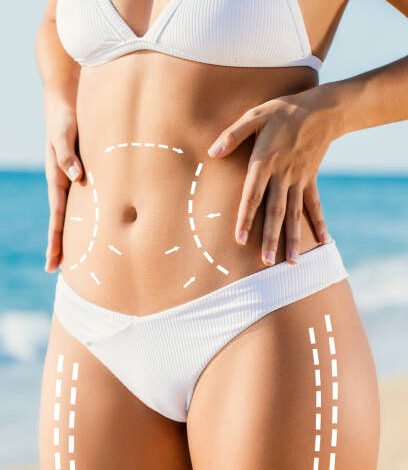 How Liposuction Can Help You Sculpt Your Body