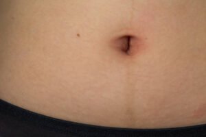 Mini Abdominoplasty for a Tighter Abdomen 