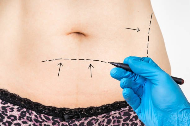 Mini Abdominoplasty for a Tighter Abdomen