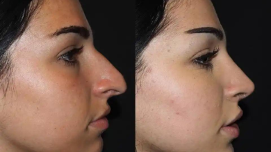 Achieve a Natural Look with Rhinoplasty in Dubai