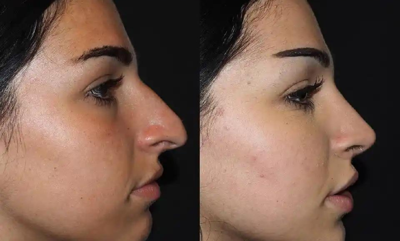 Achieve a Natural Look with Rhinoplasty in Dubai