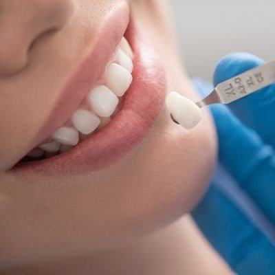 How Composite Veneers Can Fix Gaps and Discolored Teeth