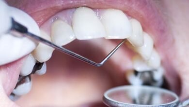 How to Tell If You Need a Dental Tooth Filling Replacement