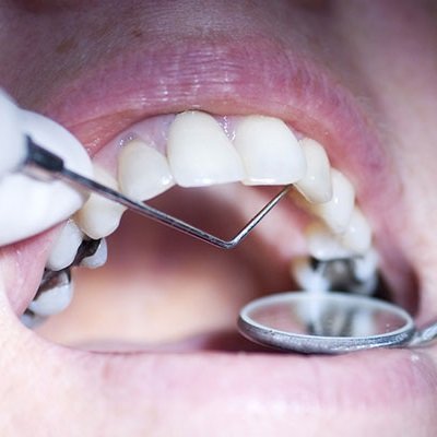 How to Tell If You Need a Dental Tooth Filling Replacement