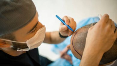 Hair Transplant in Riyadh