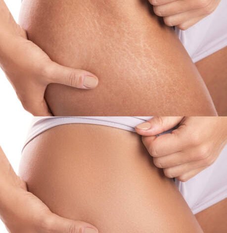 Stretch marks Removal in Abu Dhabi