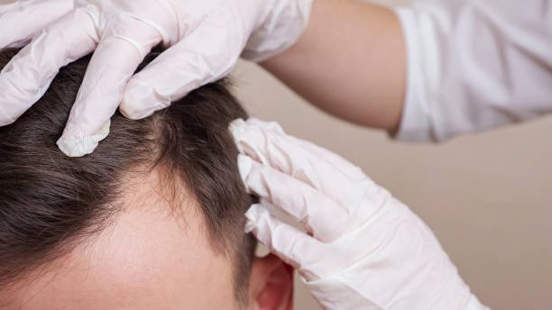 Dermatologist for Hair Loss in Abu Dhabi