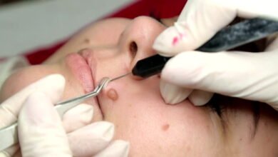 Mole Removal Treatments in Abu Dhabi