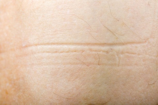 Surgical scar revision in Abu Dhabi