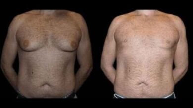 Before and After Male Breast Reduction Result