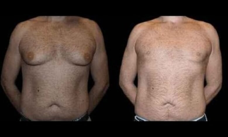 Before and After Male Breast Reduction Results