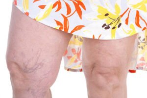 8 Tips for Post-Treatment Care of Spider Veins