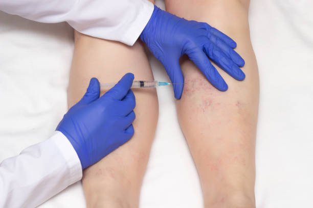 8 Tips for Post-Treatment Care of Spider Veins