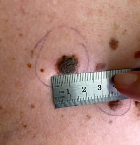 Aftercare Tips for Laser Birthmark Removal