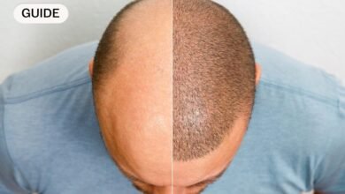 تكلفة زراعة الشعر