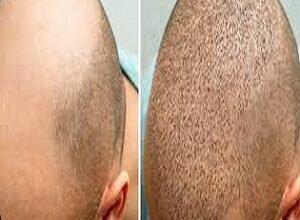 Hair Transplant in Riyadh