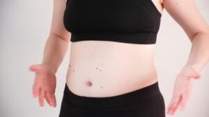 Lipo Abdominoplasty: An In-Depth Look