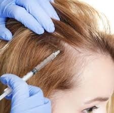 PRP Hair Injection in Dubai