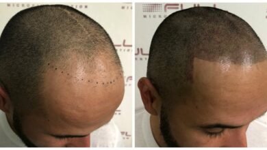 scalp micropigmentation for men