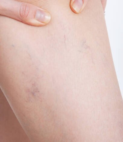 Steps to Prepare for Spider Veins Treatment