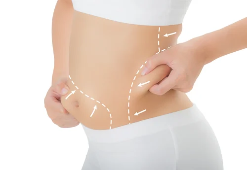 The Benefits of Liposuction In Dubai Beyond Just Aesthetics