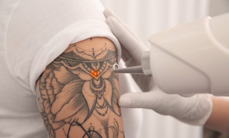 Aftercare Tips for Laser Tattoo Removal