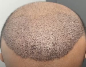 Common Myths About Crown Hair Transplants Debunked