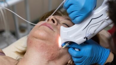 Common Myths About Laser Acne Scar Treatment