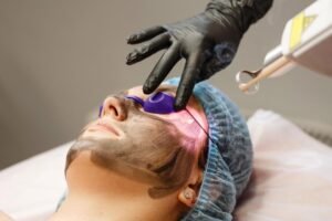 Common Myths About Spectra Laser Carbon Peel