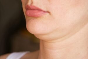 Everything You Need to Know About Double Chin Removal