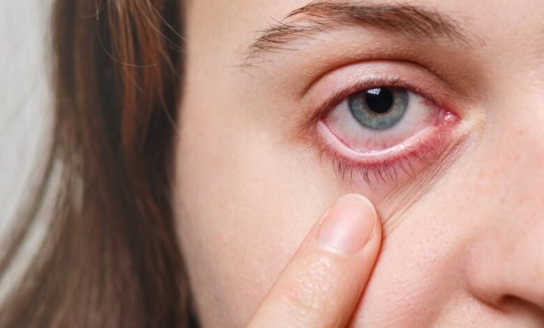 How to Spot the Symptoms of Common Eye Infections