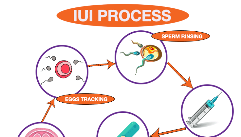 IUI Treatment