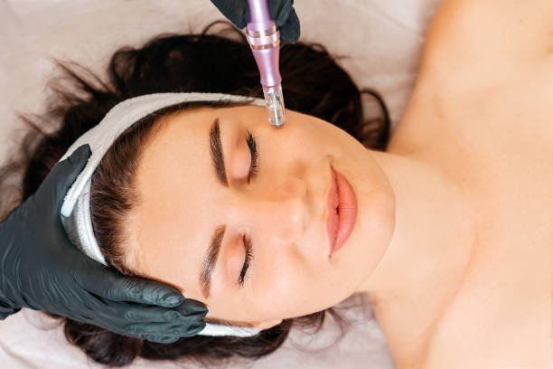 What is Microneedling and How Does It Work?