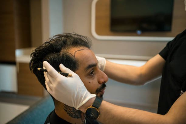 Your Guide to Natural-Looking Results with Hair Transplants