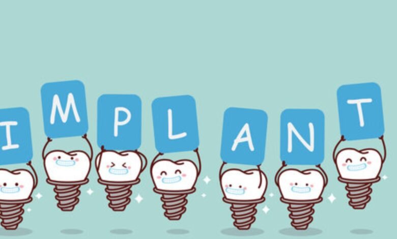 dental implants image