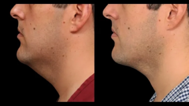 Double Chin removal