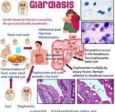 Giardiasis