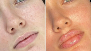 Juvederm